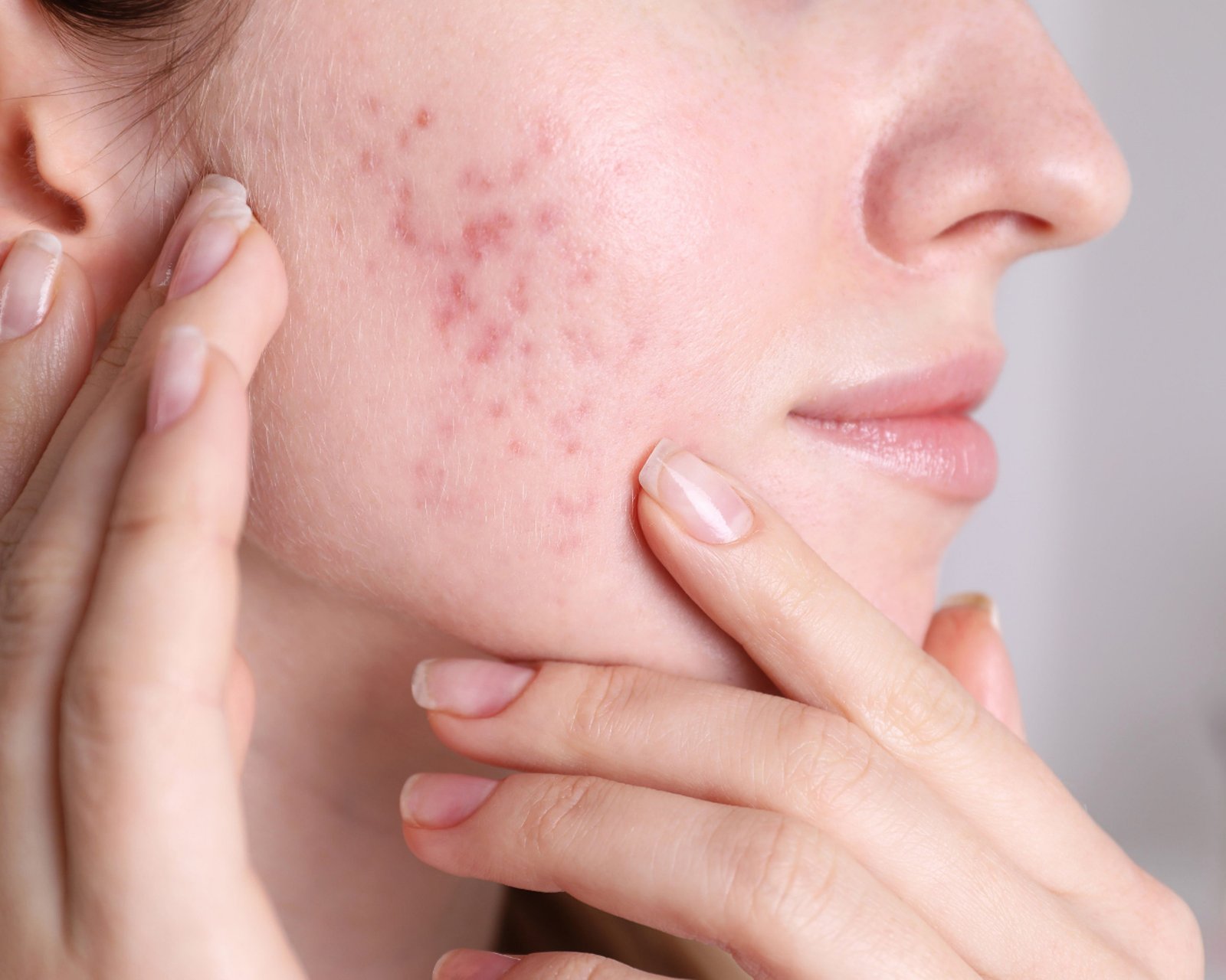Textura Facial (Poros, Cravos e Acne)