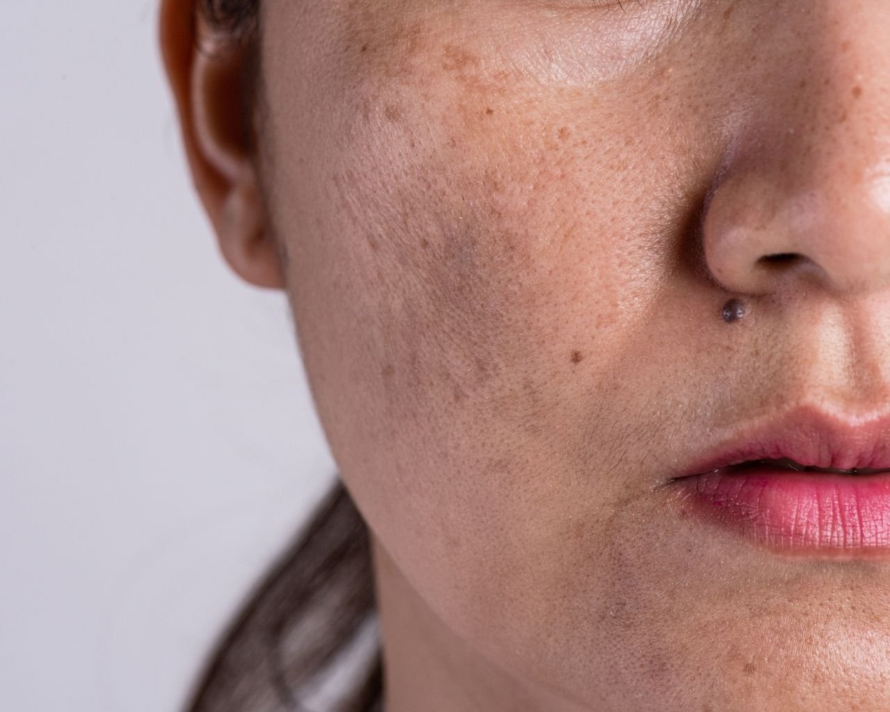 Manchas e Melasma
